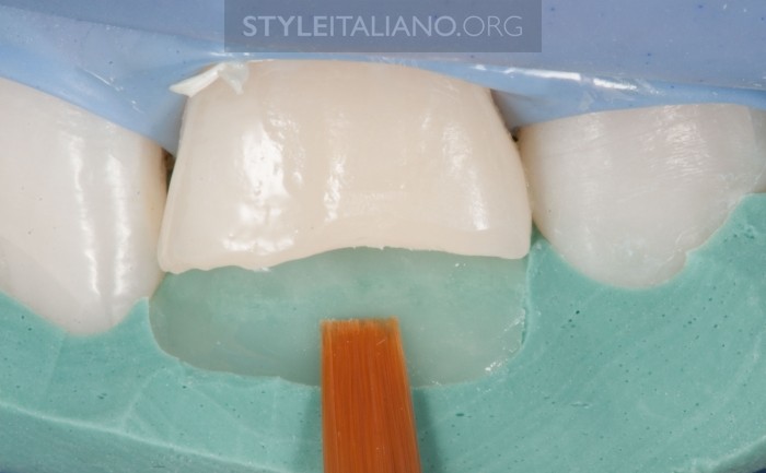 восстановление зуба