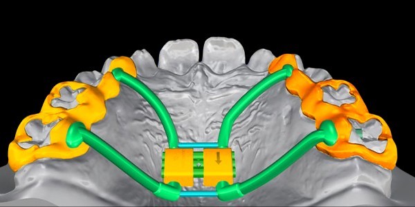 The Occlusogram - software for the implementation of orthodontic ...