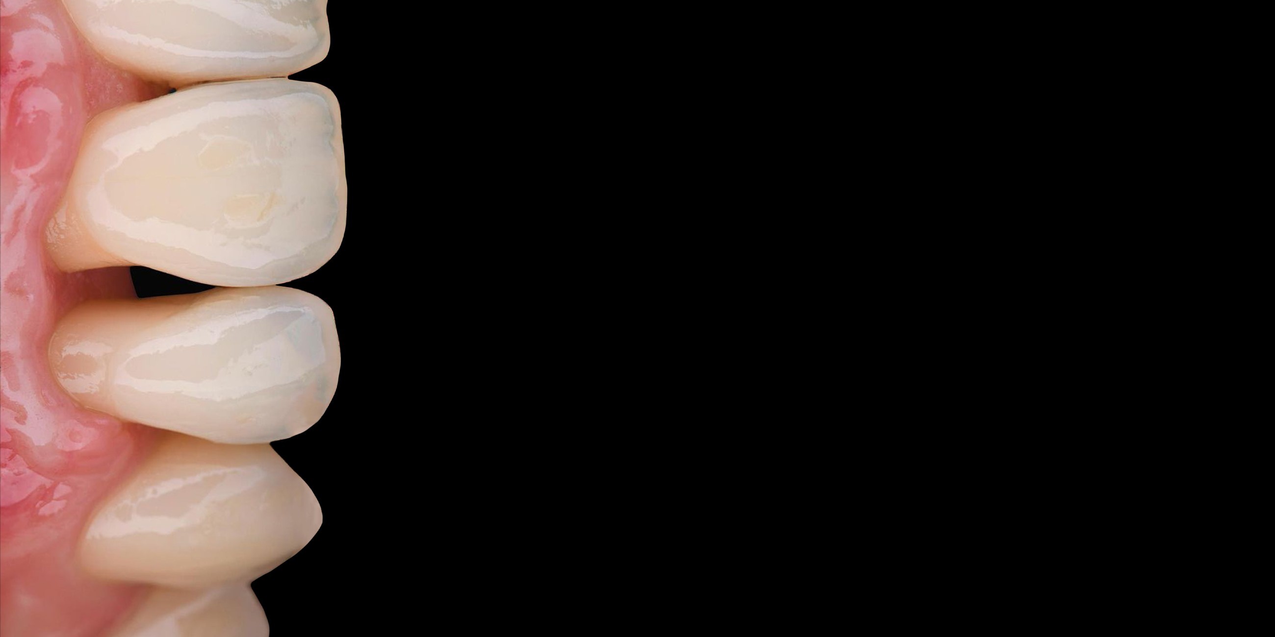 VISTA: пародонтальная пластическая хирургия. Часть 1