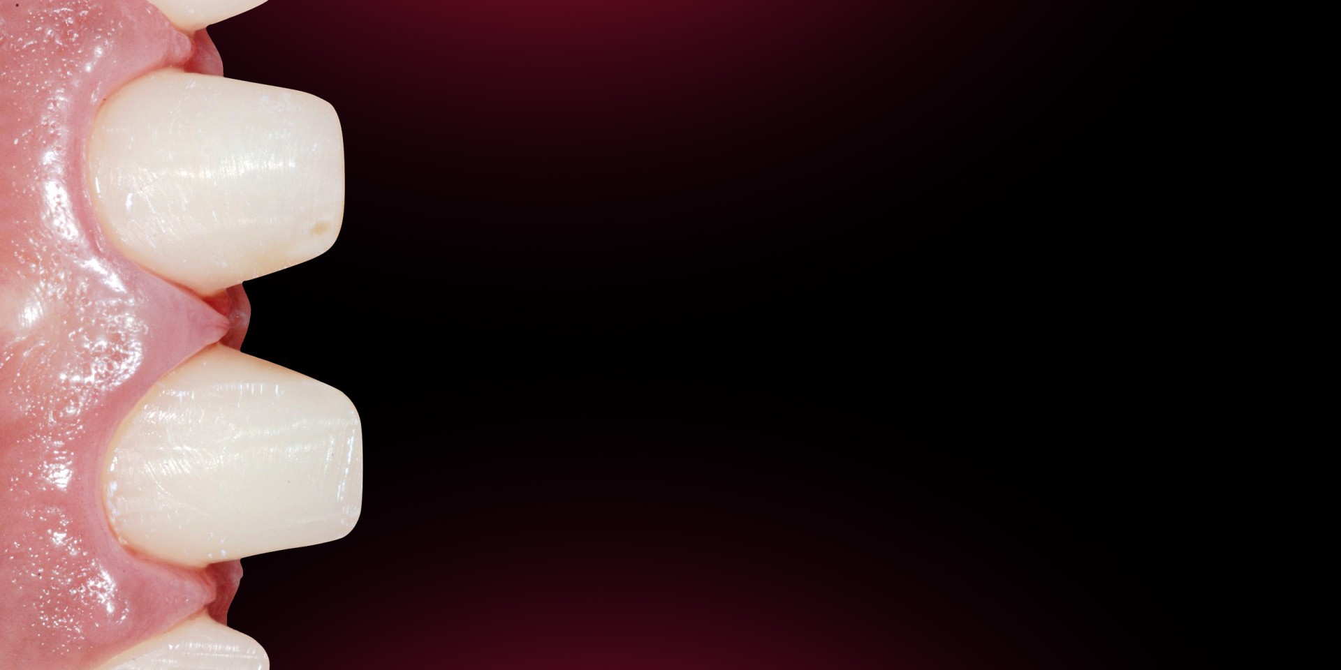 Functional and Aesthetic Anterior Laminate Veneers. Theory, Digital approach and Clinical