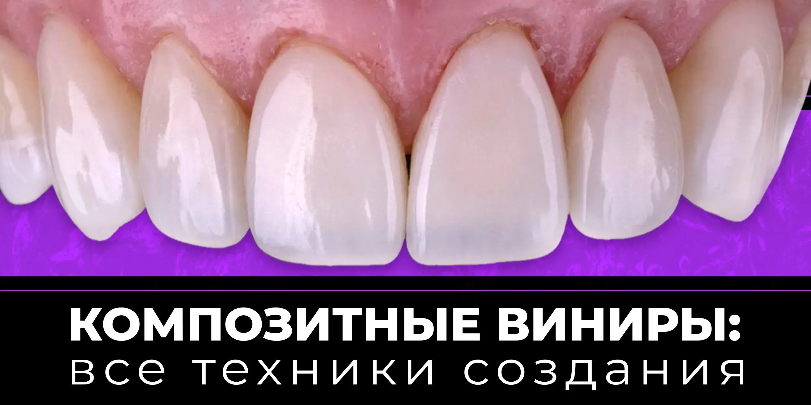 Одиночный композитный винир: коррекция формы и цвета