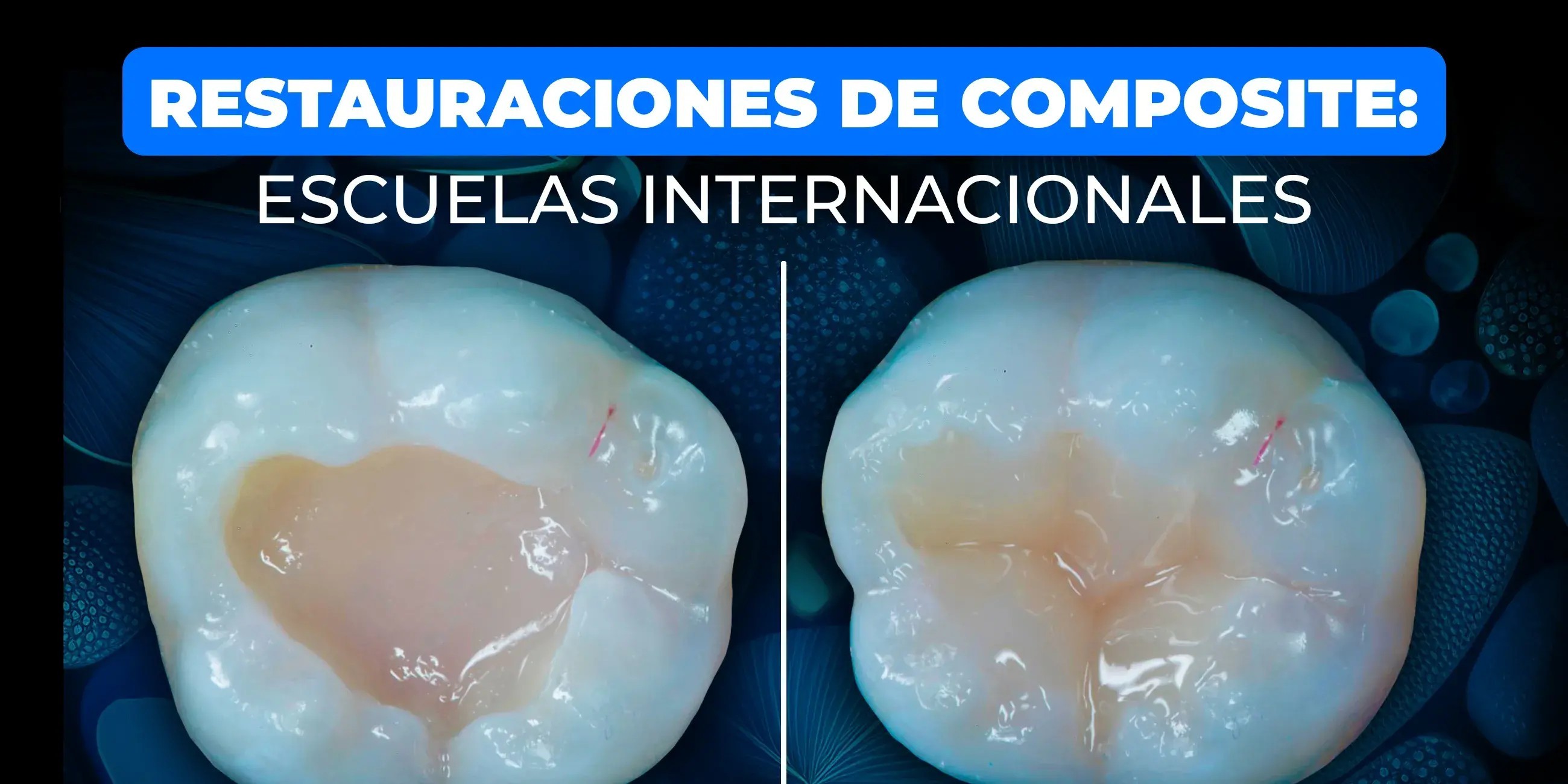 Restauración directa de dientes posteriores utilizando la técnica de