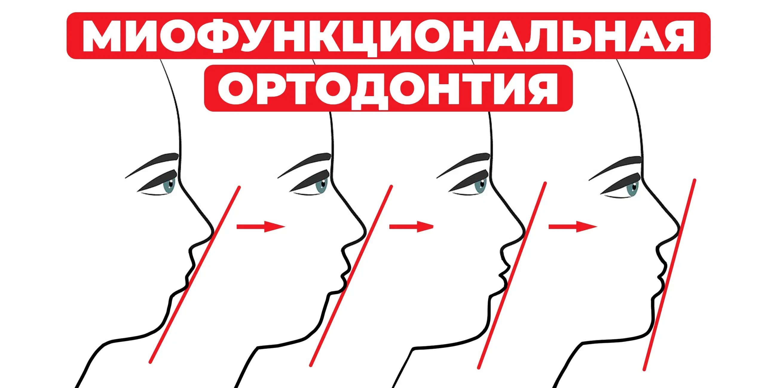 Короткая уздечка языка и орофациальные дисфункции: командный подход к ...