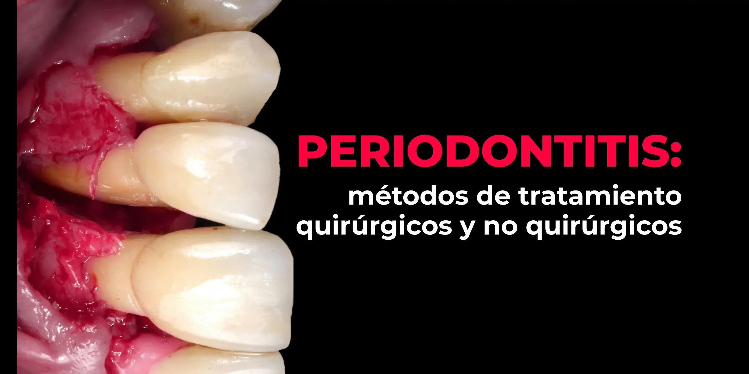 Regeneración de defectos infraóseos en pacientes periodontales
