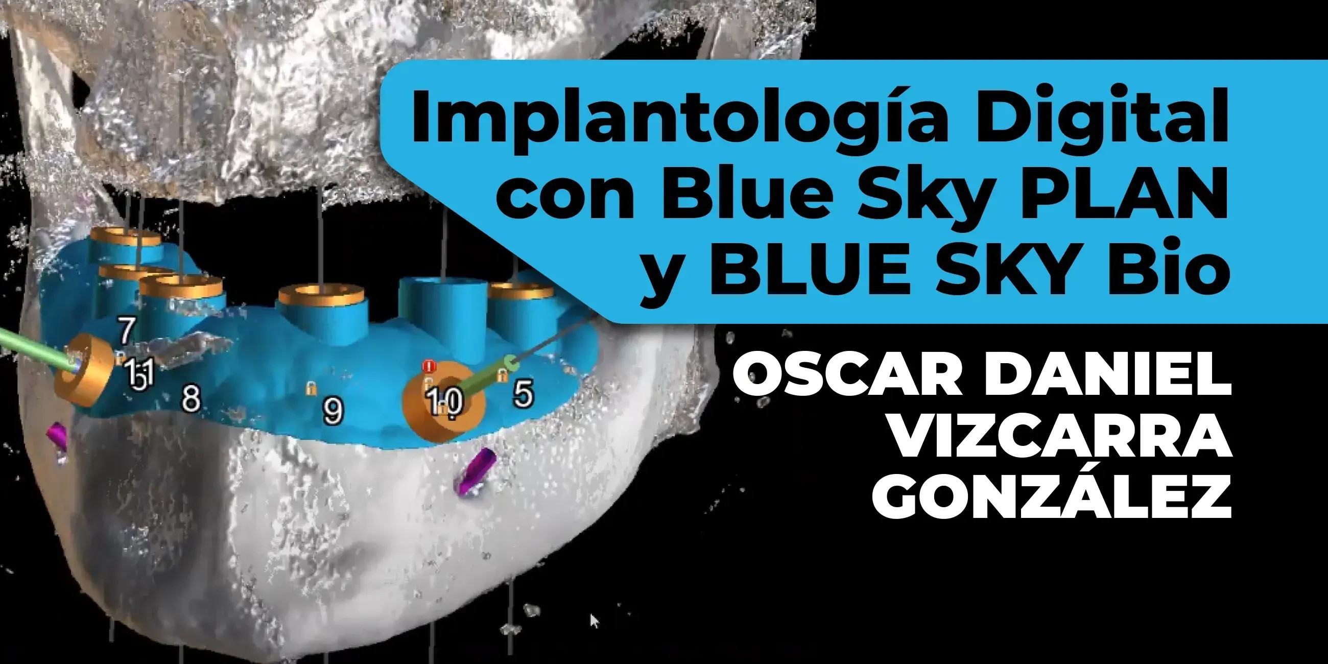 BLUE SKY PLAN: Diseño de guía quirúrgica para implantes