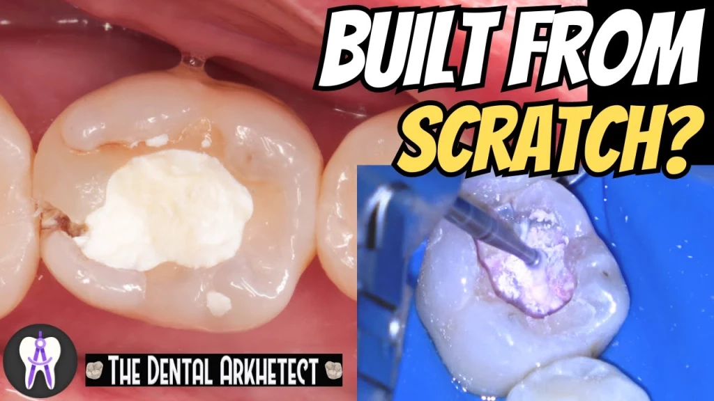 AMAZING Restoration of A Root Canal Treated Tooth