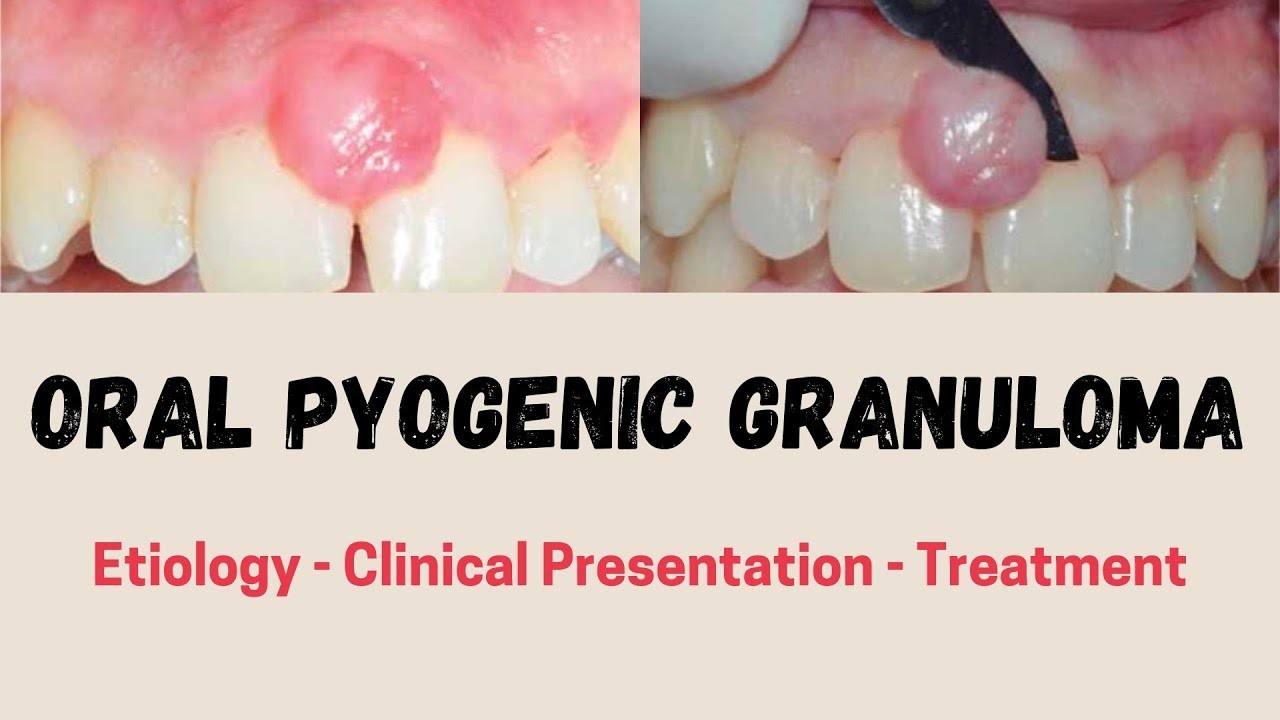 Oral Pyogenic Granuloma Etiology Clinical Presentation Treatment Oral Pyogenic Granuloma Etiology Clinical Presentation Treatment