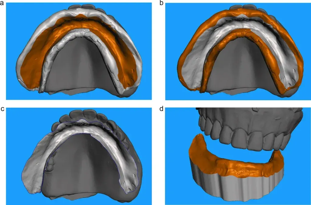 Total rehabilitation with removable dentures in Meshmixer