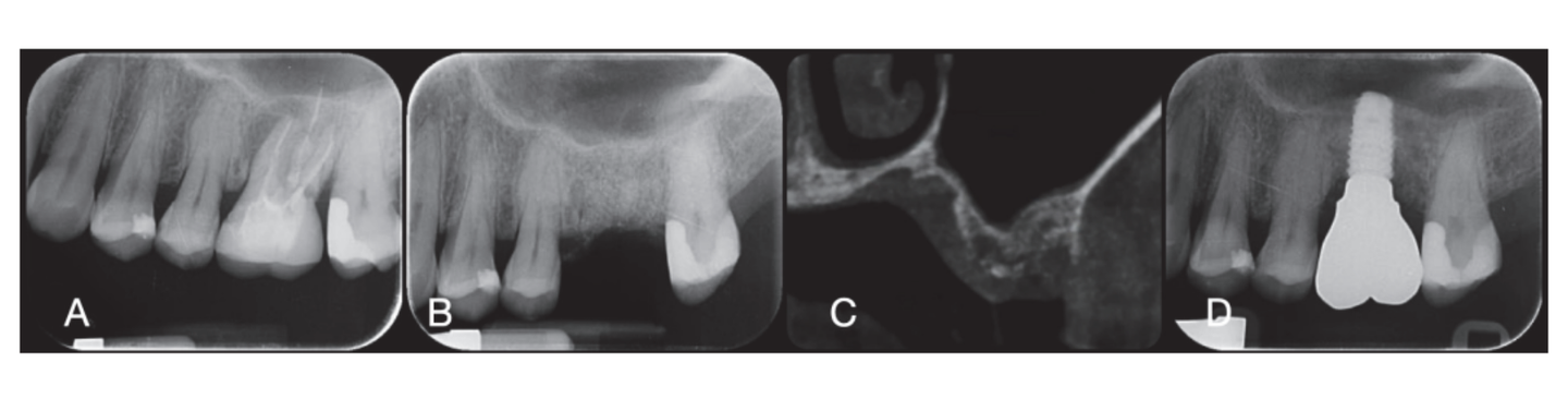 Evaluating Clinical and Histological Outcomes of Implant-Supported ...