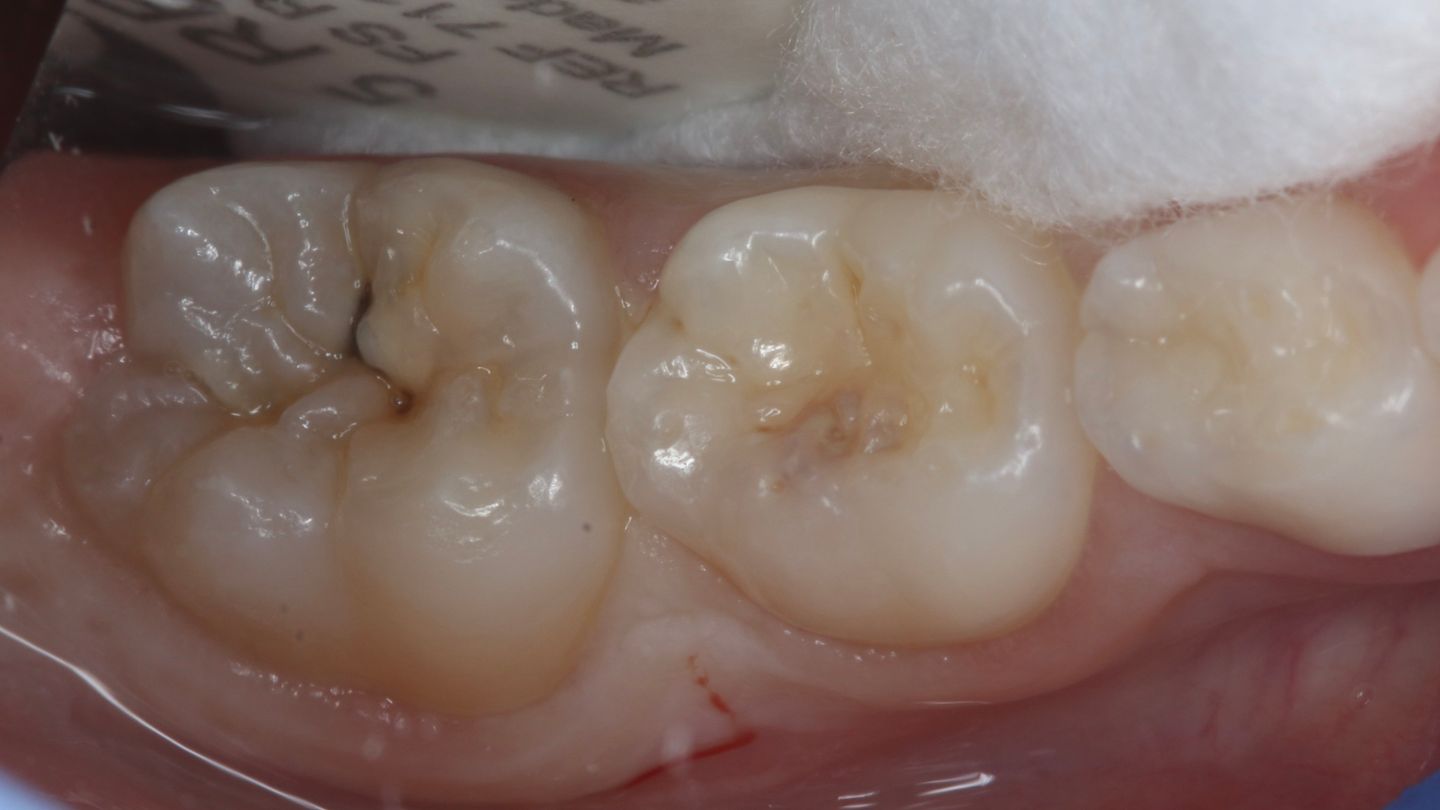 Glass ionomer cement, EQUIA, EverX, Endodontically treated