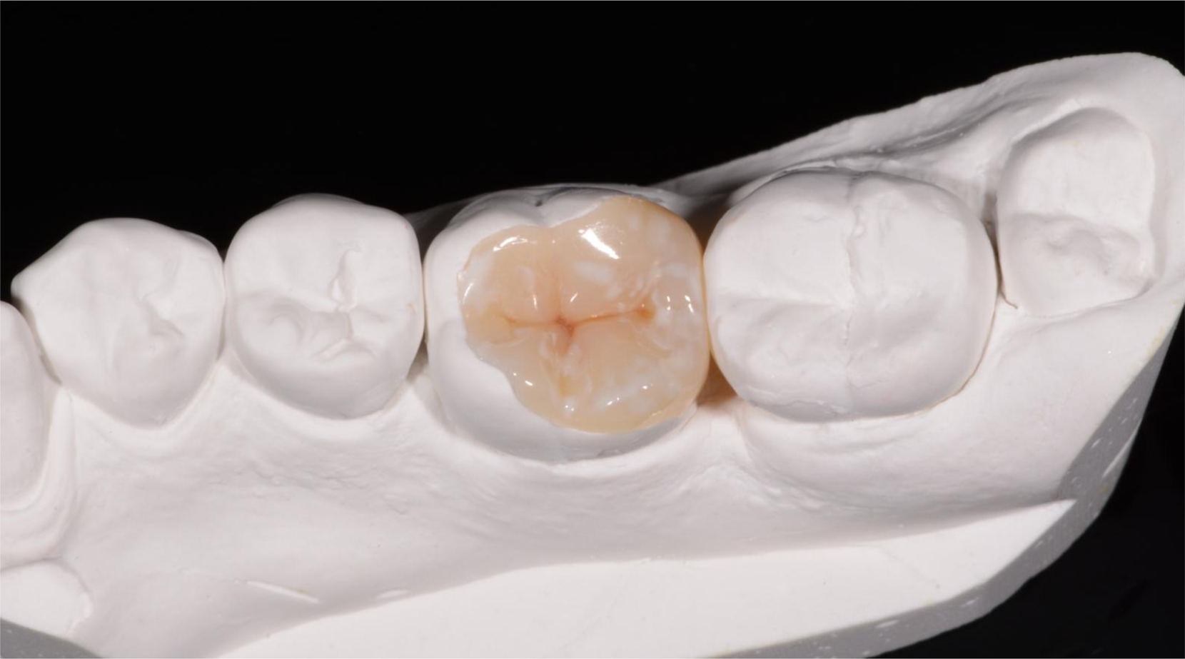 Formation of cavities for pinlay and overlay inlays