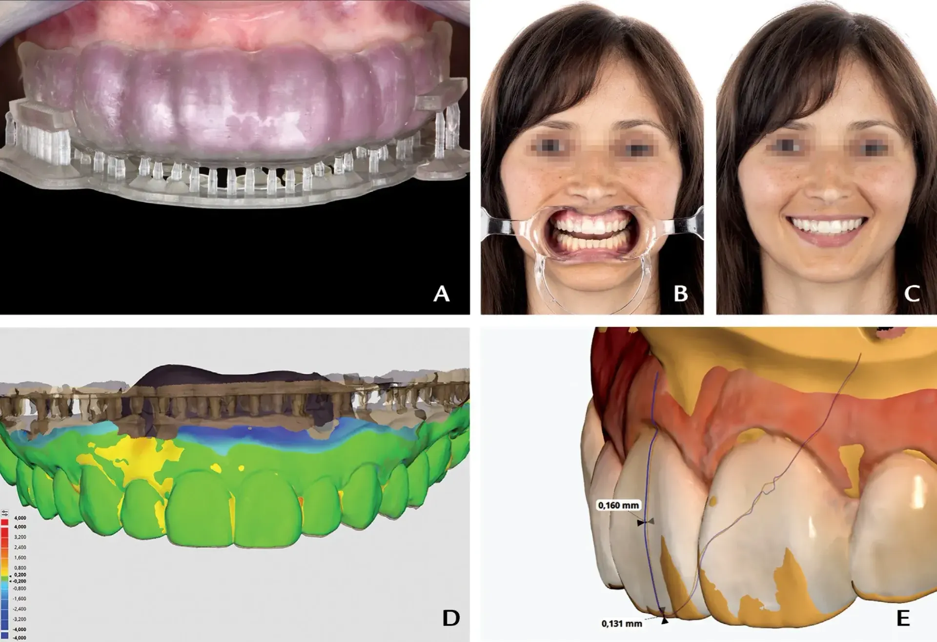 Fabrication technique of a CAD/CAM matrix for trial restorations