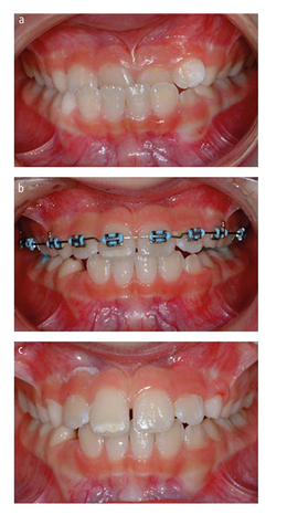 Early Orthodontic Treatment for Class III Malocclusions