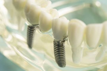 Tratamiento Mínimamente Invasivo de Maxilares Edéntulos con Sobredentadura Totalmente Soportada por una Barra de Titanio Cad/Cam con un Conector de Bajo Perfil Atornillado en Cuatro o Seis Implantes: Una Serie de Casos Tratamiento Mínimamente Invasivo de Maxilares Edéntulos con Sobredentadura Totalmente Soportada por una Barra de Titanio Cad/Cam con un Conector de Bajo Perfil Atornillado en Cuatro o Seis Implantes: Una Serie de Casos
