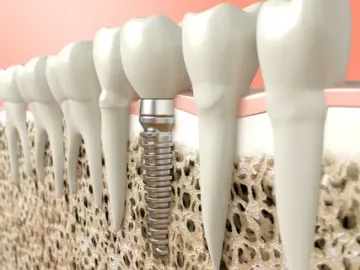 Osseointegration and factors influencing it Osseointegration and factors influencing it