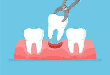 Autotransplantation of Teeth