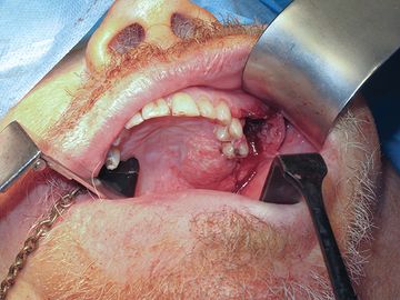 Implantation for the rehabilitation of patients with neoplasms