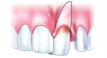 Traumatismo dentário. Diagnóstico e tratamento