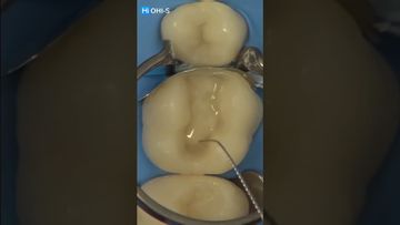 Restauración de dientes frontales del Dr. Alessandro Pezzana