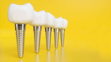 Classification Systems for Peri-implantitis: A Narrative Review with a Proposal of a New Evidence-Based Etiology Codification