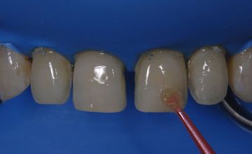 Fixation of ceramic veneers while preserving enamel