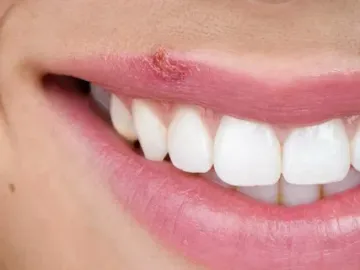 Malattie precancerose della mucosa orale Malattie precancerose della mucosa orale
