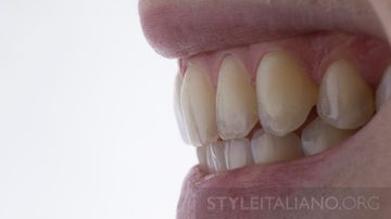 Removing white spots on teeth