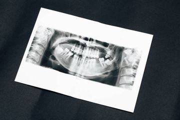 Evaluación del grosor de la dentina de los canales mesiales medios de molares mandibulares preparados con instrumentos rotatorios: un estudio de micro-CT