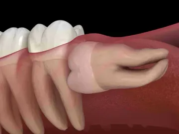 Болезни прорезывания зубов