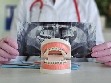 Ortodontia e toxina botulínica: Cuidado integrado de um paciente com bruxismo e alteração oclusal Ortodontia e toxina botulínica: Cuidado integrado de um paciente com bruxismo e alteração oclusal