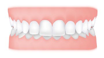 General Characteristics of Deep Bite