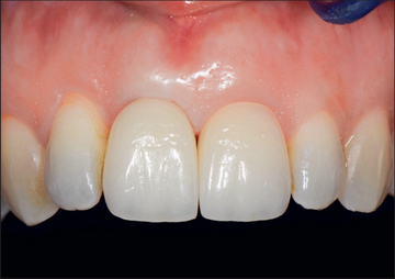 Clinical Considerations on Strategies That Avoid Multiple Connections and Disconnections of Implant Abutments