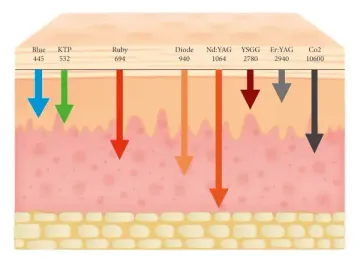 Er,Cr:YSGG 2780 nm Laser Treatment of Lip Melanin Hyperpigmentation