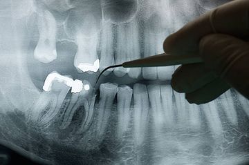 A new system for classifying root and root canal morphology