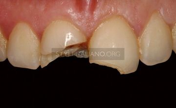 Restoration of extensive crown fracture Restoration of extensive crown fracture