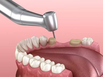 Influenza del protocollo di essiccazione con alcol isopropilico sulla resistenza di adesione dei sigillanti a base di resina alla dentina radicolare