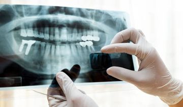 Effects of root canal enlargement on unprepared areas and coronal dentine thickness of three-rooted maxillary first premolars with different root configurations: A stepwise micro-CT study