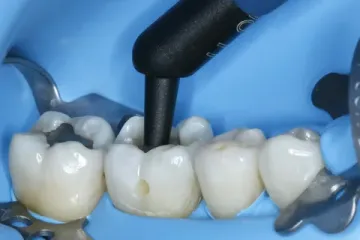 Sequence of restoration of chewing teeth