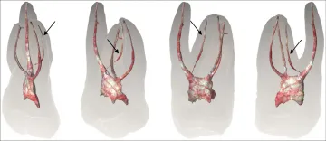 Identification and Characterization of a Previously Undiscovered Anatomical Structure in Maxillary Second Molars: The Palato-Mesiobuccal Canal