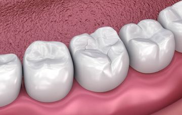 Gestione endodontica dei denti autotrapiantati Gestione endodontica dei denti autotrapiantati