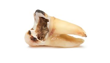 Periodontitis apical crónica