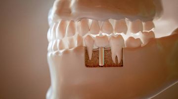 OT-Equator® Attachments Comparison for Retaining an Early Loaded Implant Overdenture on Two or Three Implants: 1 Year RCT Preliminary Data