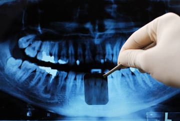 Zusätzliche Schritte zur Entfernung von Hartgewebsresten aus den anatomischen Komplexitäten des mesialen Wurzelkanalsystems von mandibulären Molaren: Eine mikro-Computertomografische Studie