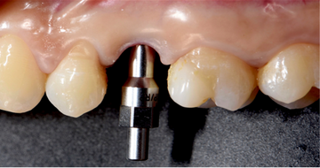 Implant Fracture: A Narrative Literature Review