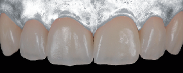 Digital Smile Design (DSD) para facetas feldespáticas non-prep Digital Smile Design (DSD) para facetas feldespáticas non-prep