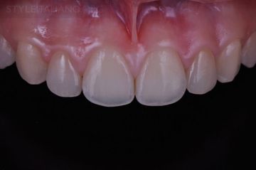 Closing the diastema without preparation