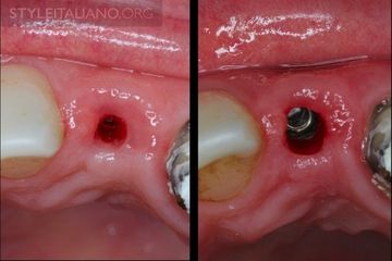 Herstellung eines Gingivaformers