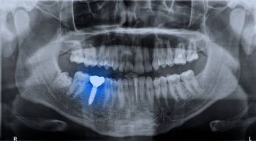 Flusso di lavoro digitale migliorato per riabilitare un paziente edentulo con una protesi su impianti in 4 appuntamenti: Un caso clinico Flusso di lavoro digitale migliorato per riabilitare un paziente edentulo con una protesi su impianti in 4 appuntamenti: Un caso clinico