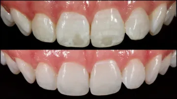 Resin Infiltration of Non-Cavitated Enamel Lesions in Paediatric Dentistry: A Narrative Review