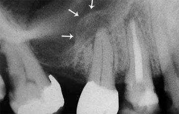 Etiology and clinic of chronic periostitis